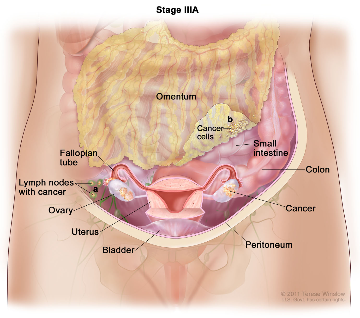 Stage IIIA Ovarian, Fallopian, and Primary Peritoneal Cancer