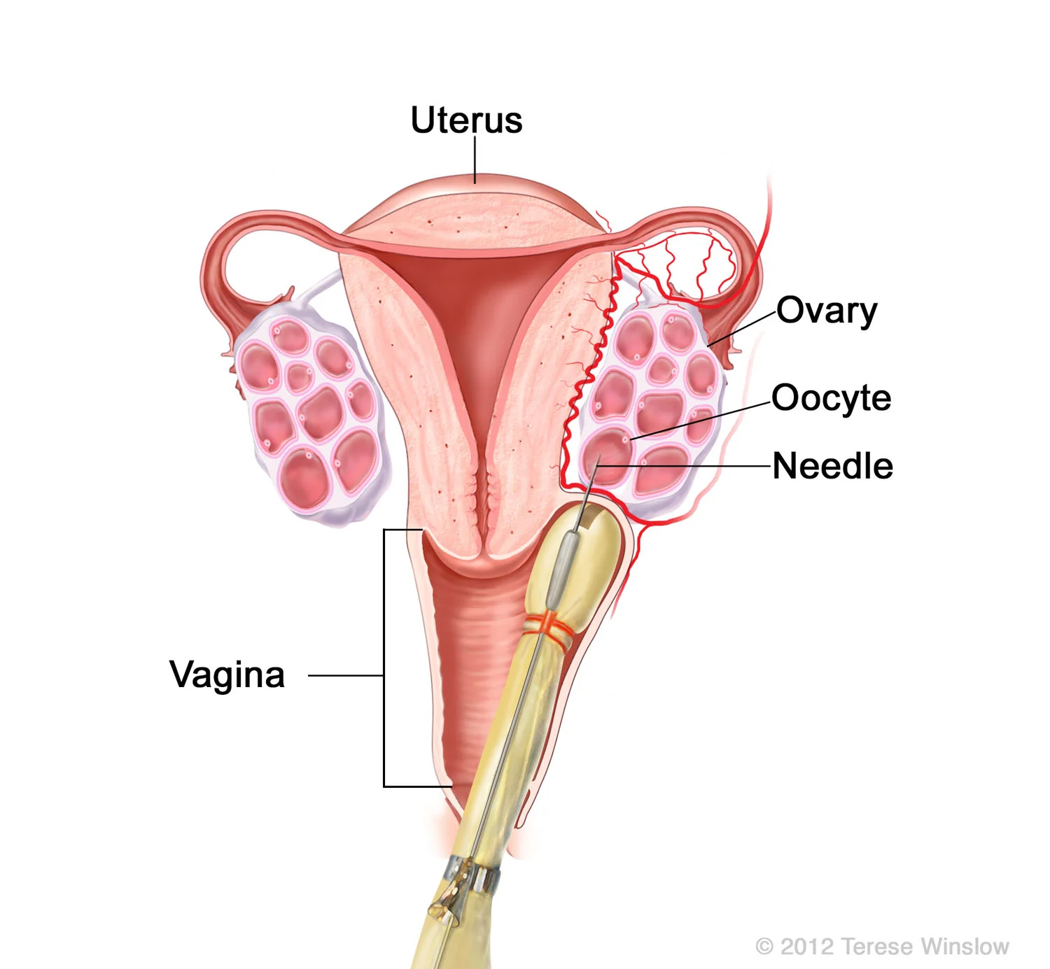 ovary-egg-retrieval-coronal.jpg