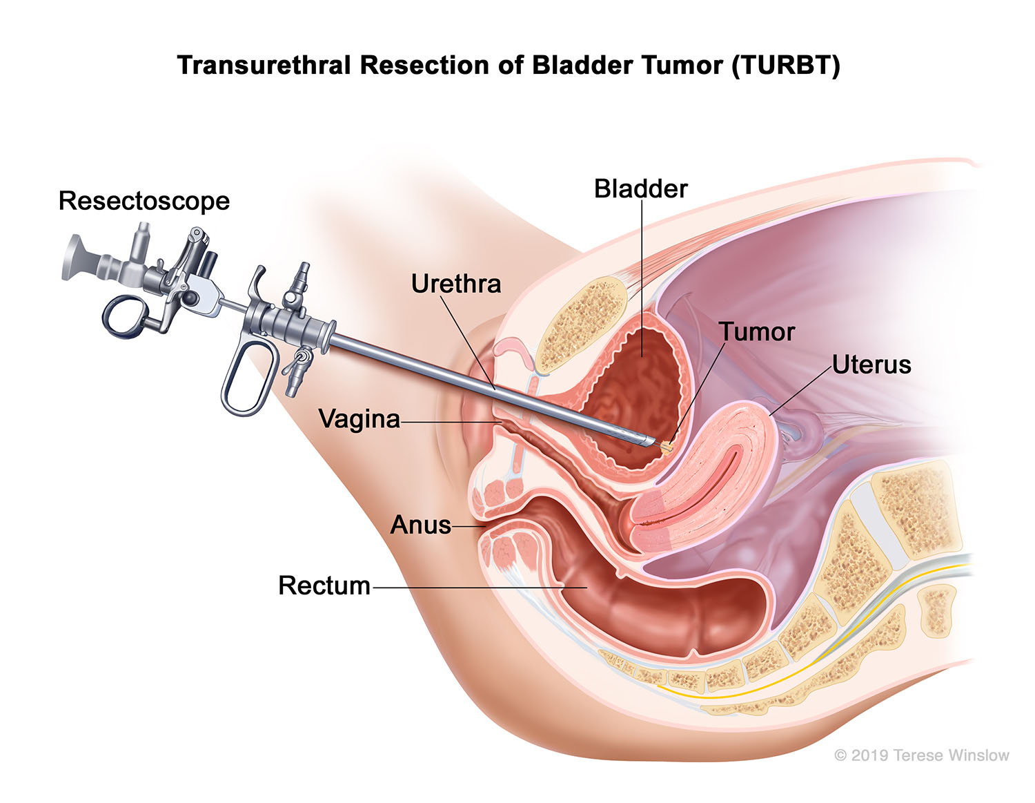 Transurethral Resection of Bladder Tumor (TURBT)