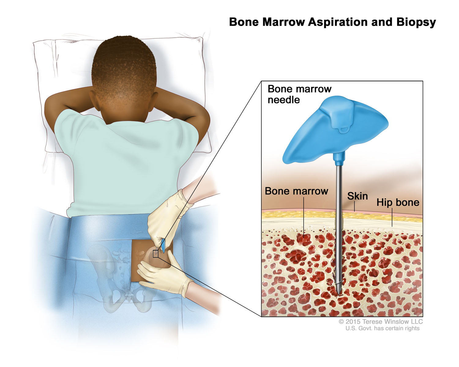 Bone Marrow Aspiration and Biopsy (Brown)