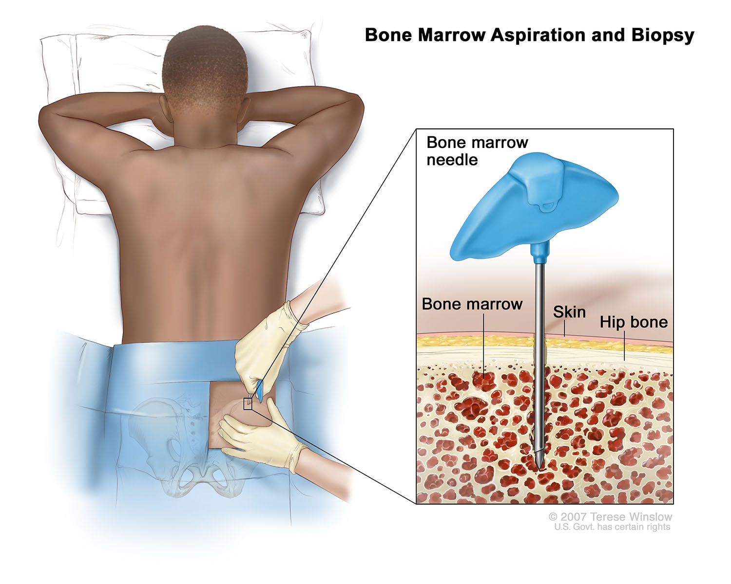 Bone Marrow Aspiration and Biopsy (Brown)