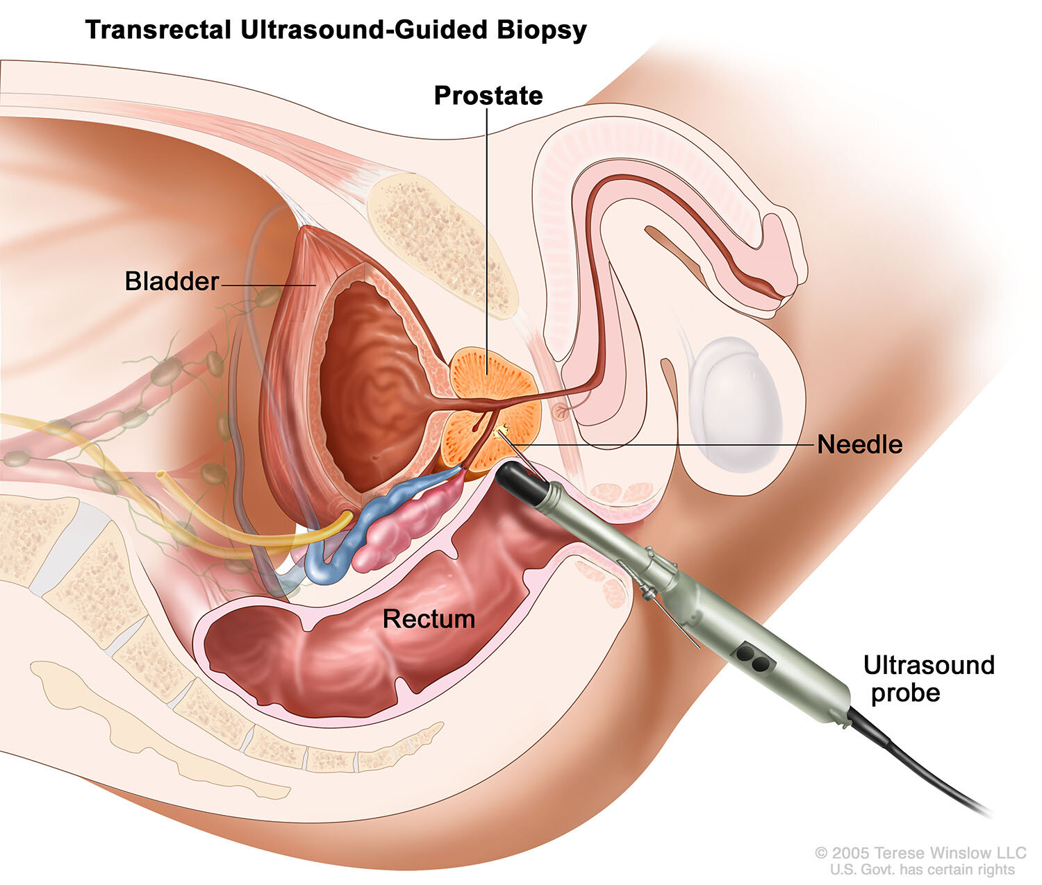 Transrectal Ultrasound-Guided Biopsy