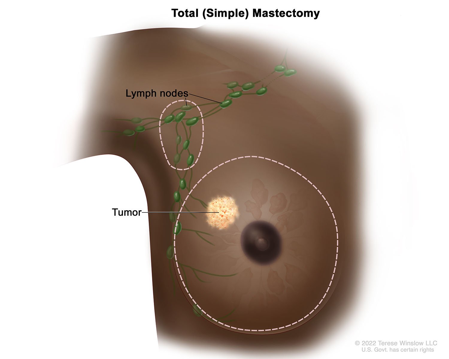 Total (Simple) Mastectomy (Brown Skin)