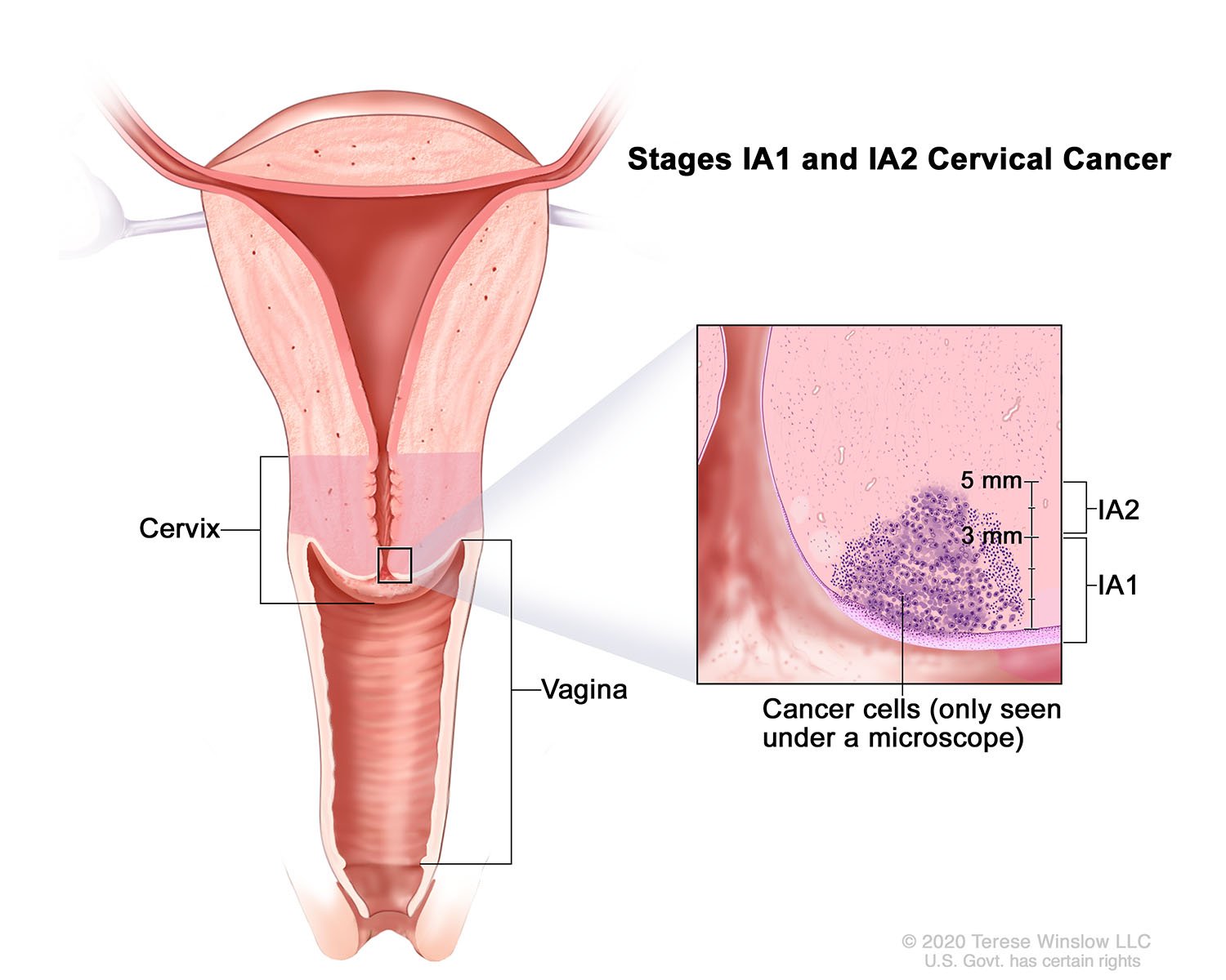 Stages IA1 and IA2 Cervical Cancer