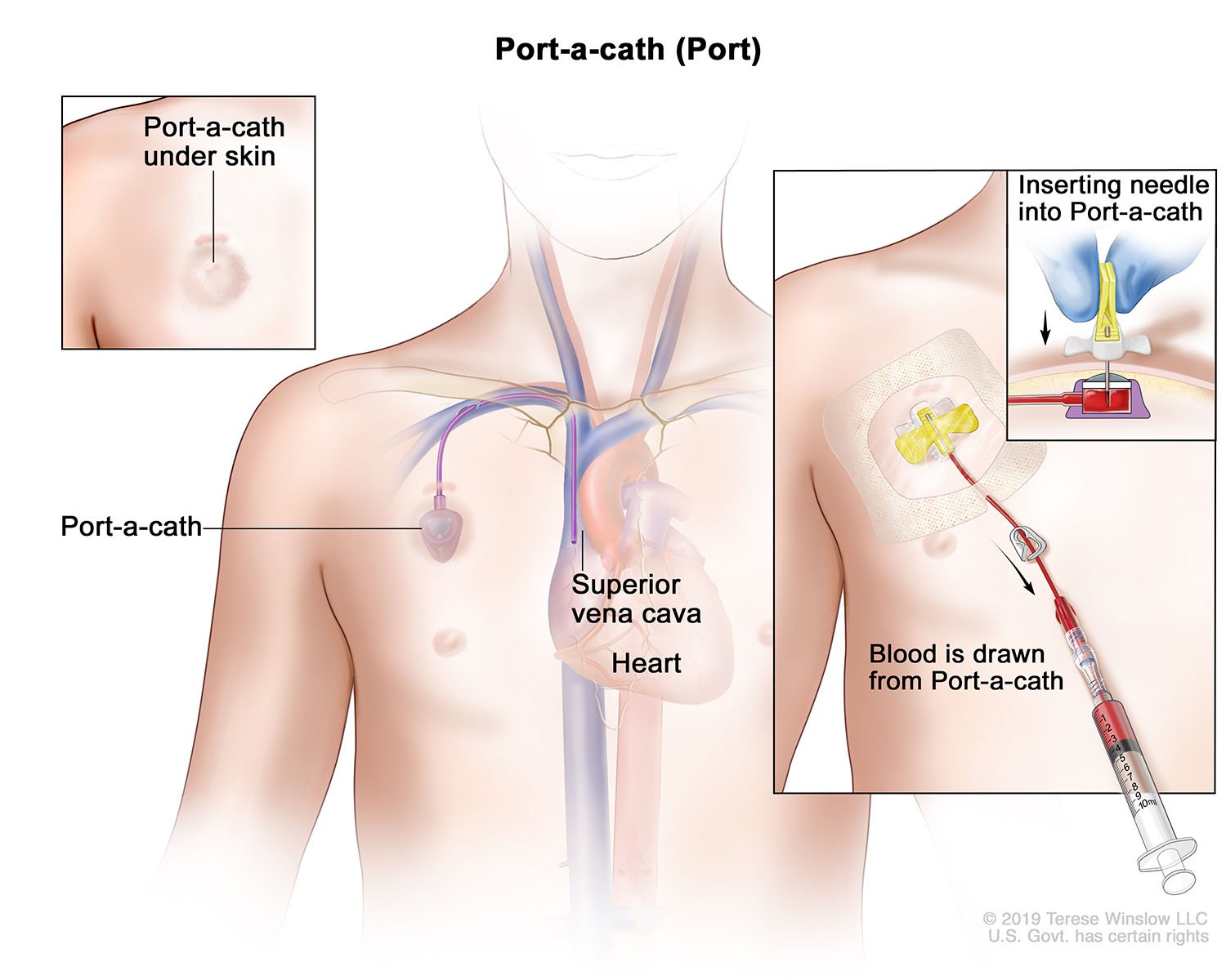 Port-a-cath (Port)