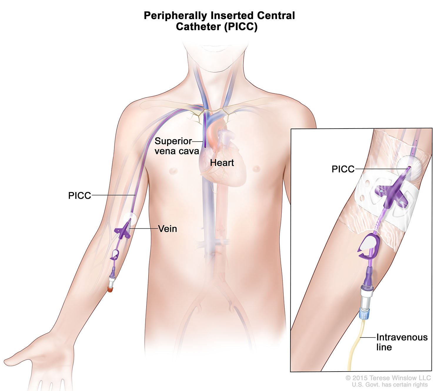 Peripherally Inserted Central Catheter (PICC)