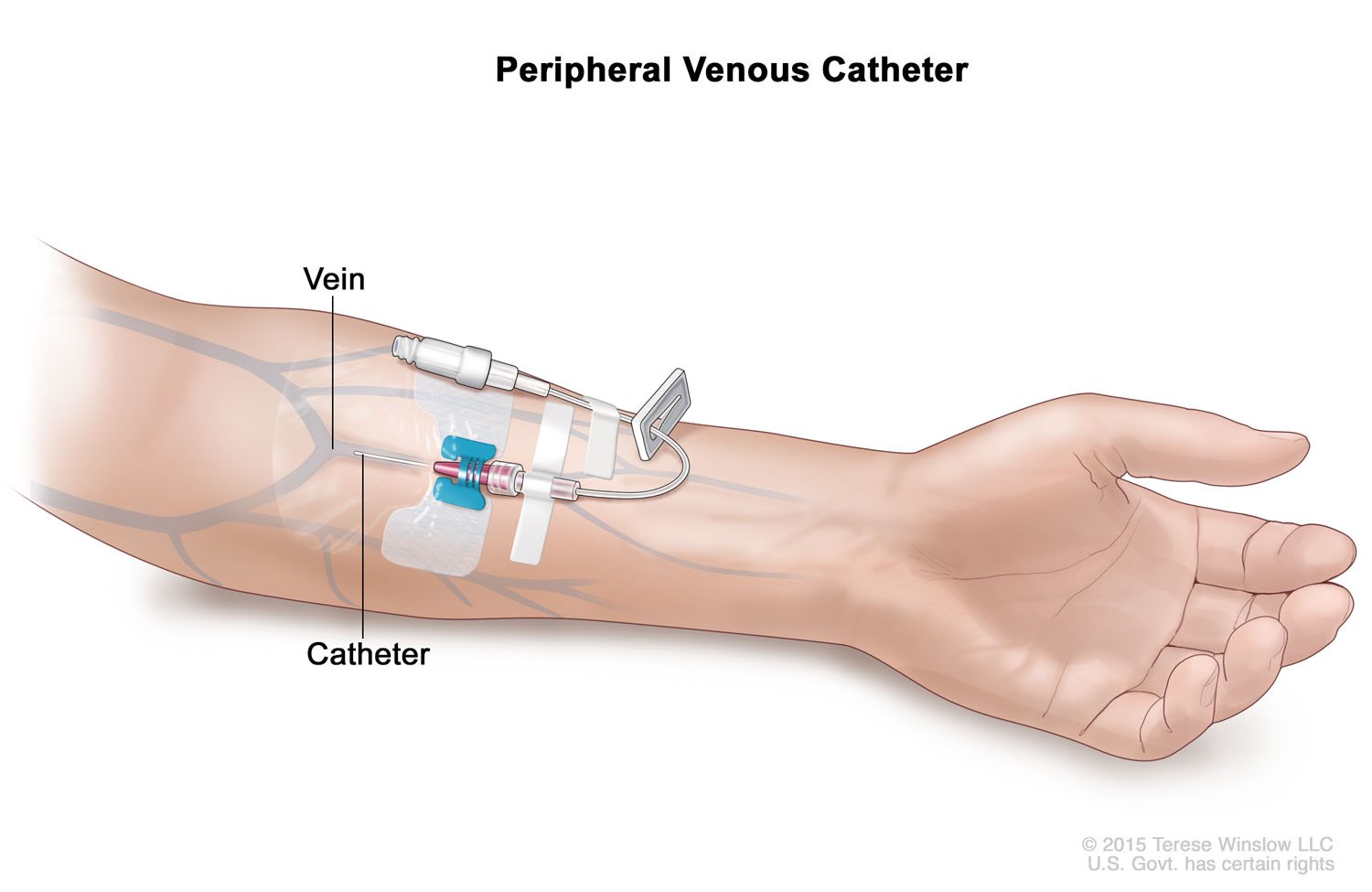 Peripheral Venous Catheter