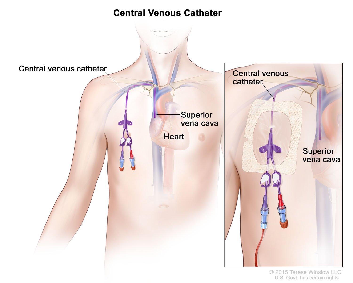 Central Venous Catheter