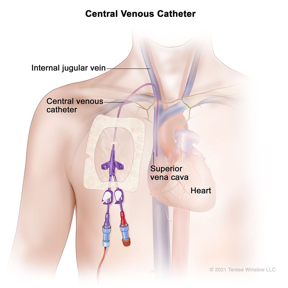 Central Venous Catheter Jugular Access