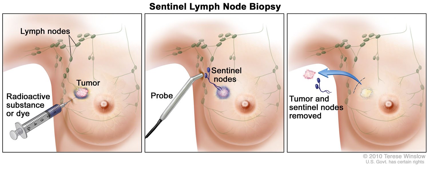 Biopsy, Sentinel Lymph Node, Breast (3-Panel)