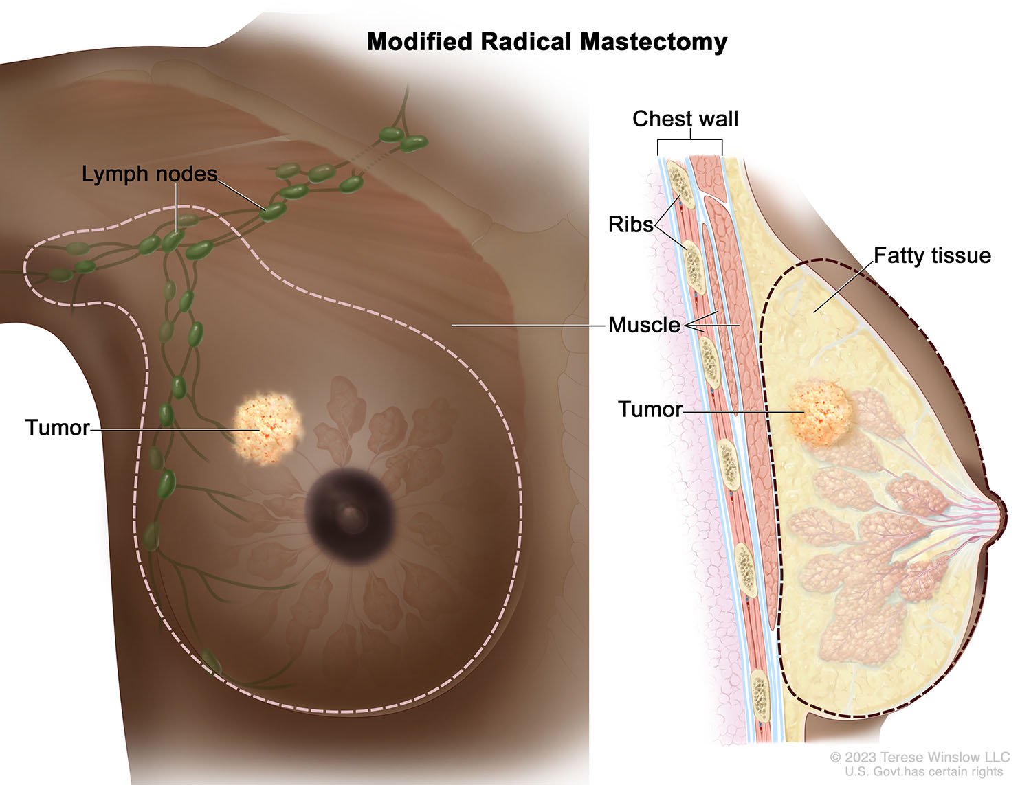 Mastectomy, Modified Radical (Brown skin)