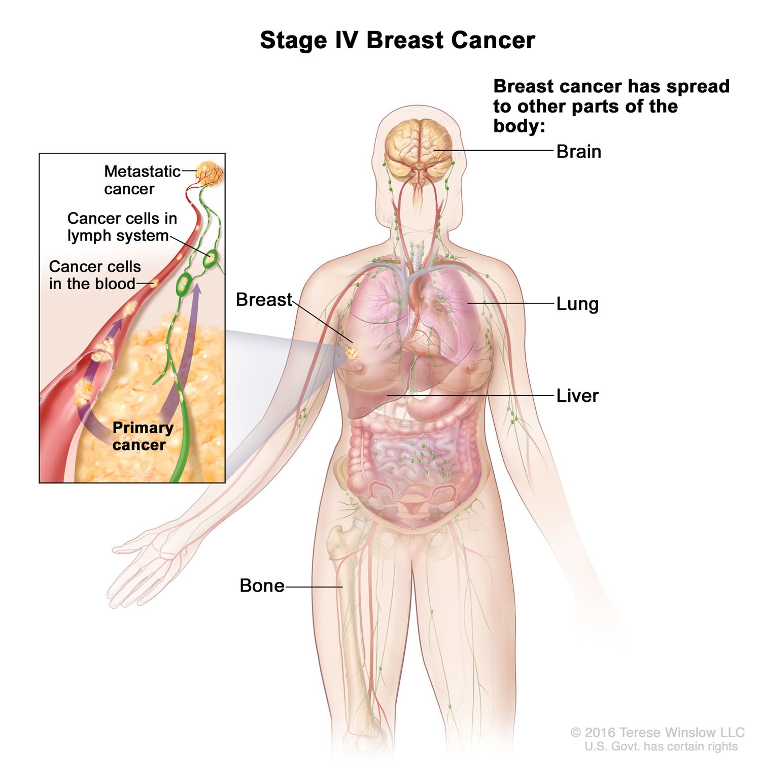 Breast Cancer, Female, Stage IV 2016