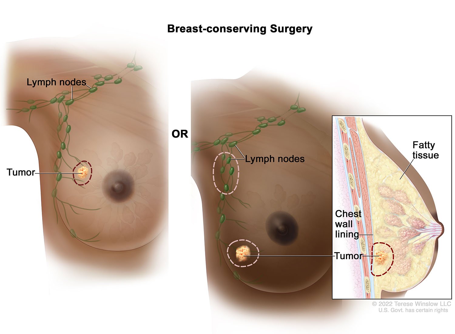 Breast-Conserving Surgery, Female (Brown skin-light and dark) 2022