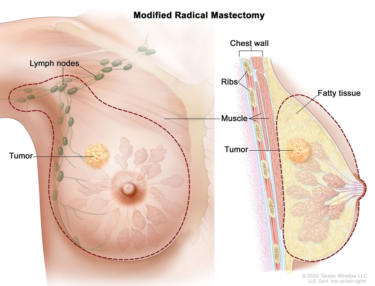 Modified Radical Mastectomy 2022