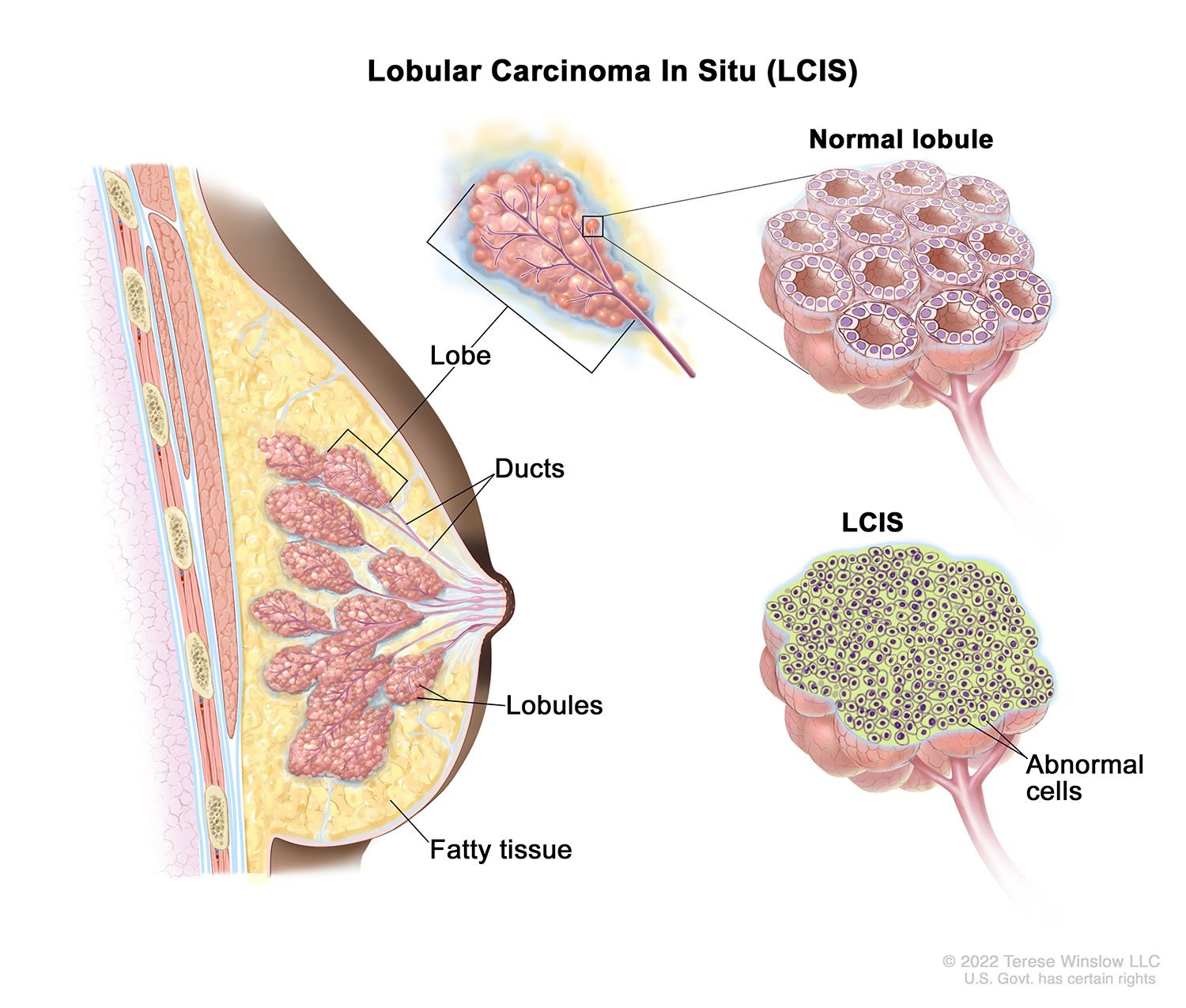 Lobular Carcinoma In Situ (LCIS) (Brown Skin) 2022
