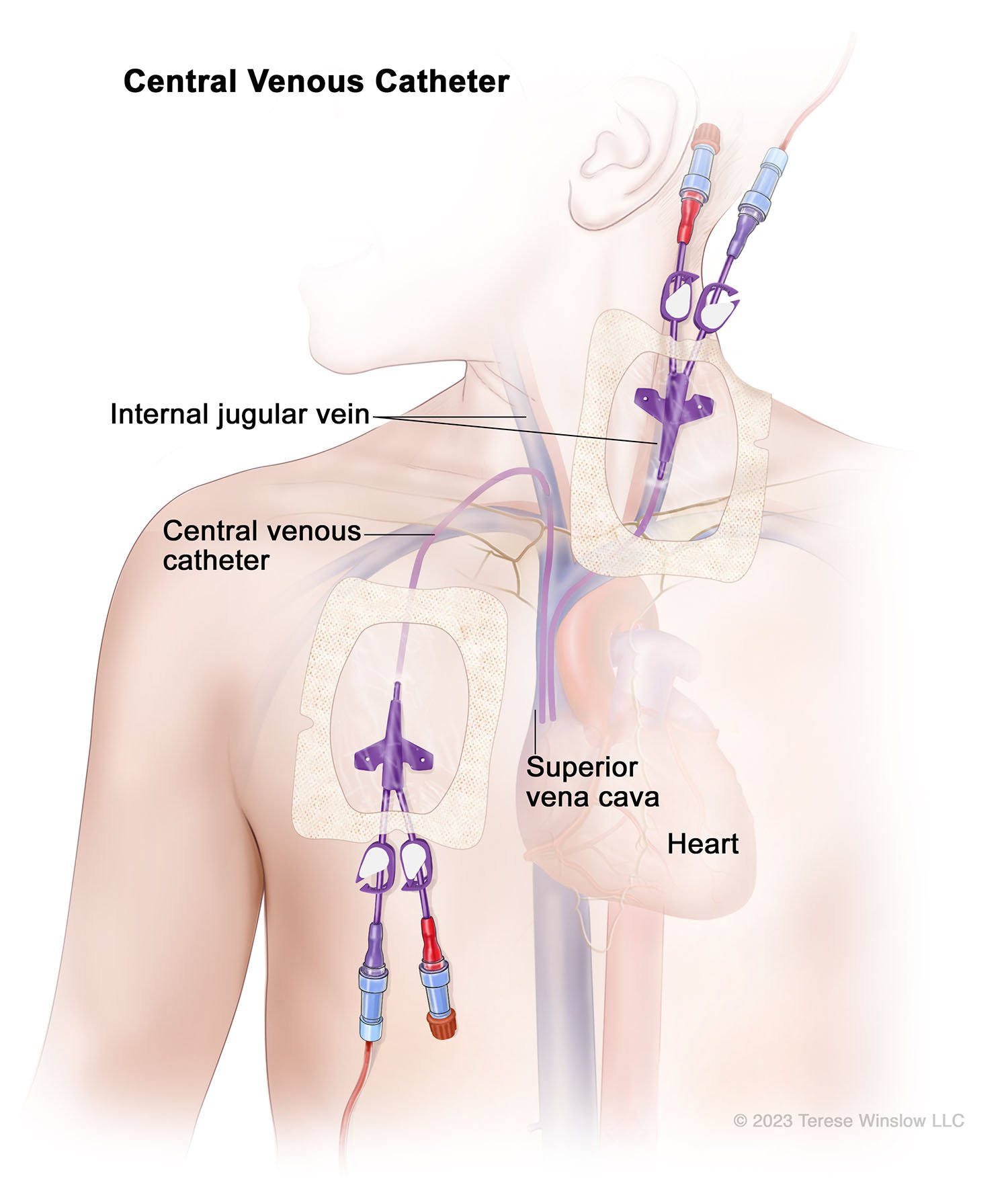 Central Venous Catheter Jugular Access 2