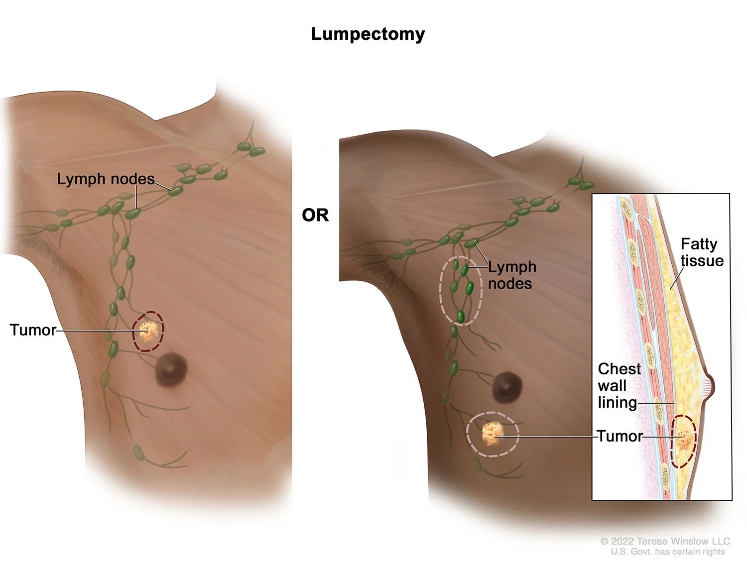 Lumpectomy Male © 2022