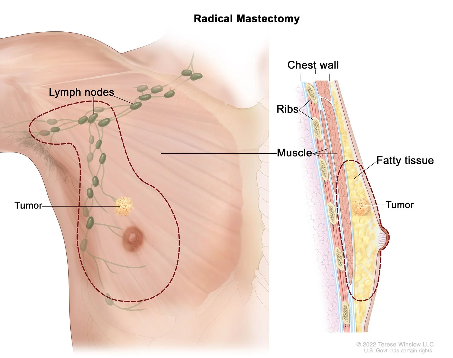 Radical Mastectomy, Male © 2022