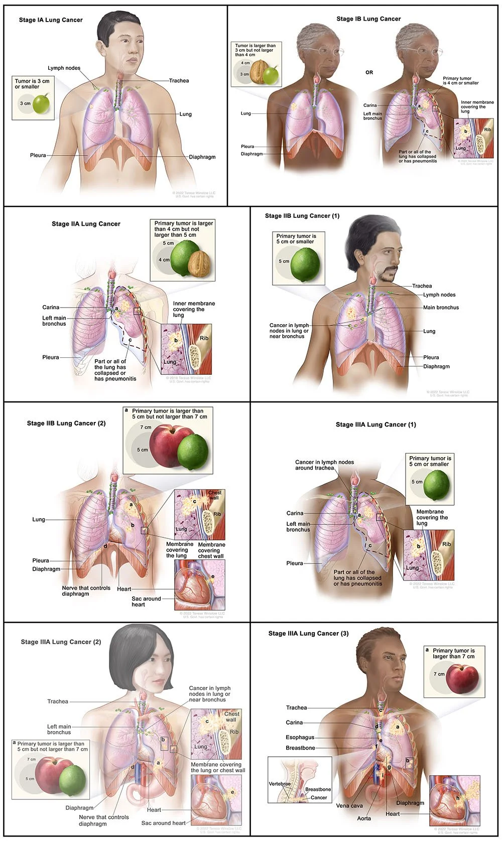 Non-Small Cell Cancer Staging (AJCC 8th Edition, (8 of 13 stages)