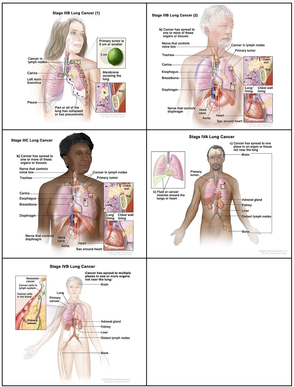 Non-Small Cell Cancer Staging (AJCC 8th Edition, (5 of 13 stages)