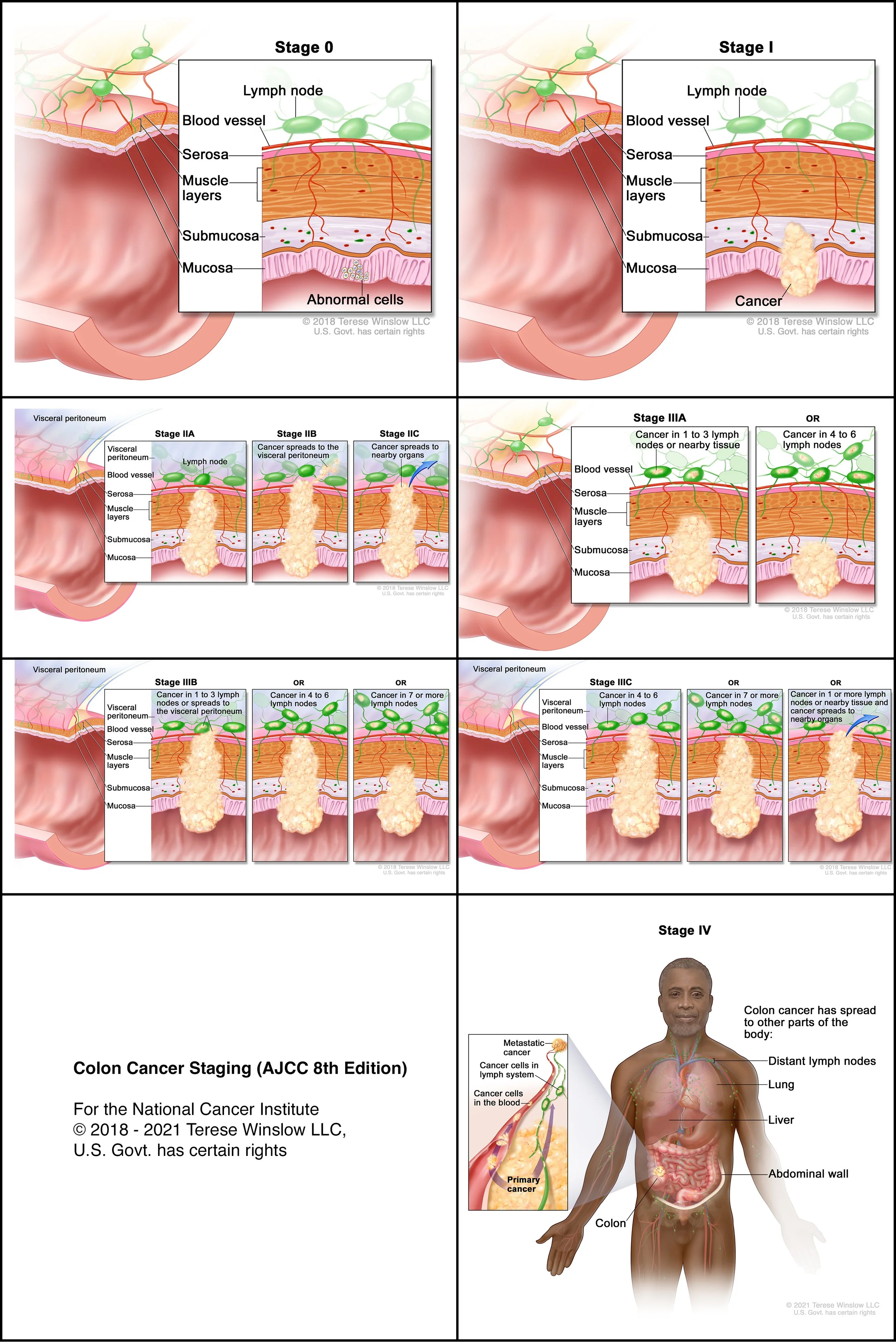 Colon Cancer Staging (AJCC 8th Edition)
