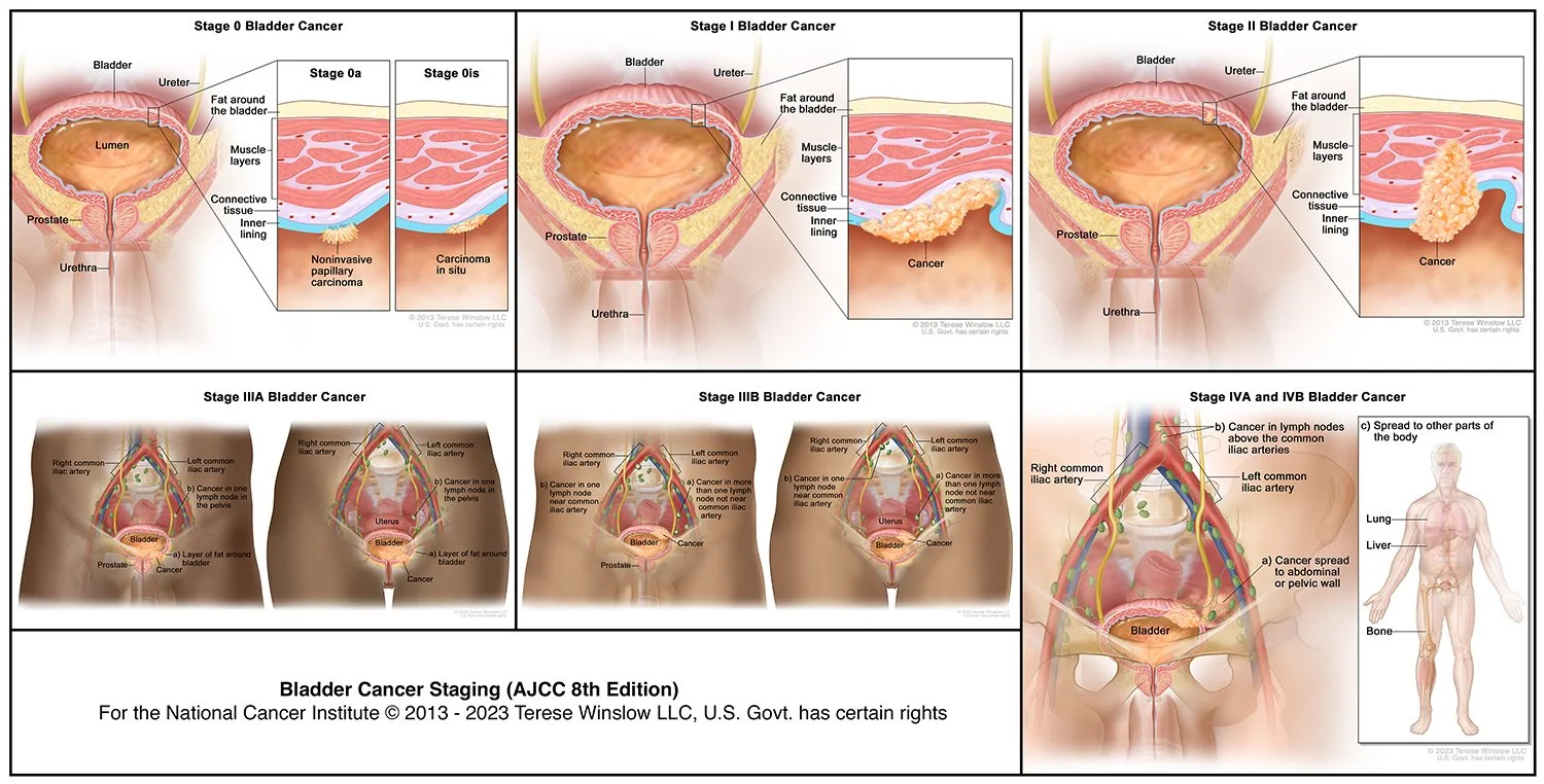 Bladder Cancer Stages (AJCC 8th edition) © 2013 - 2023