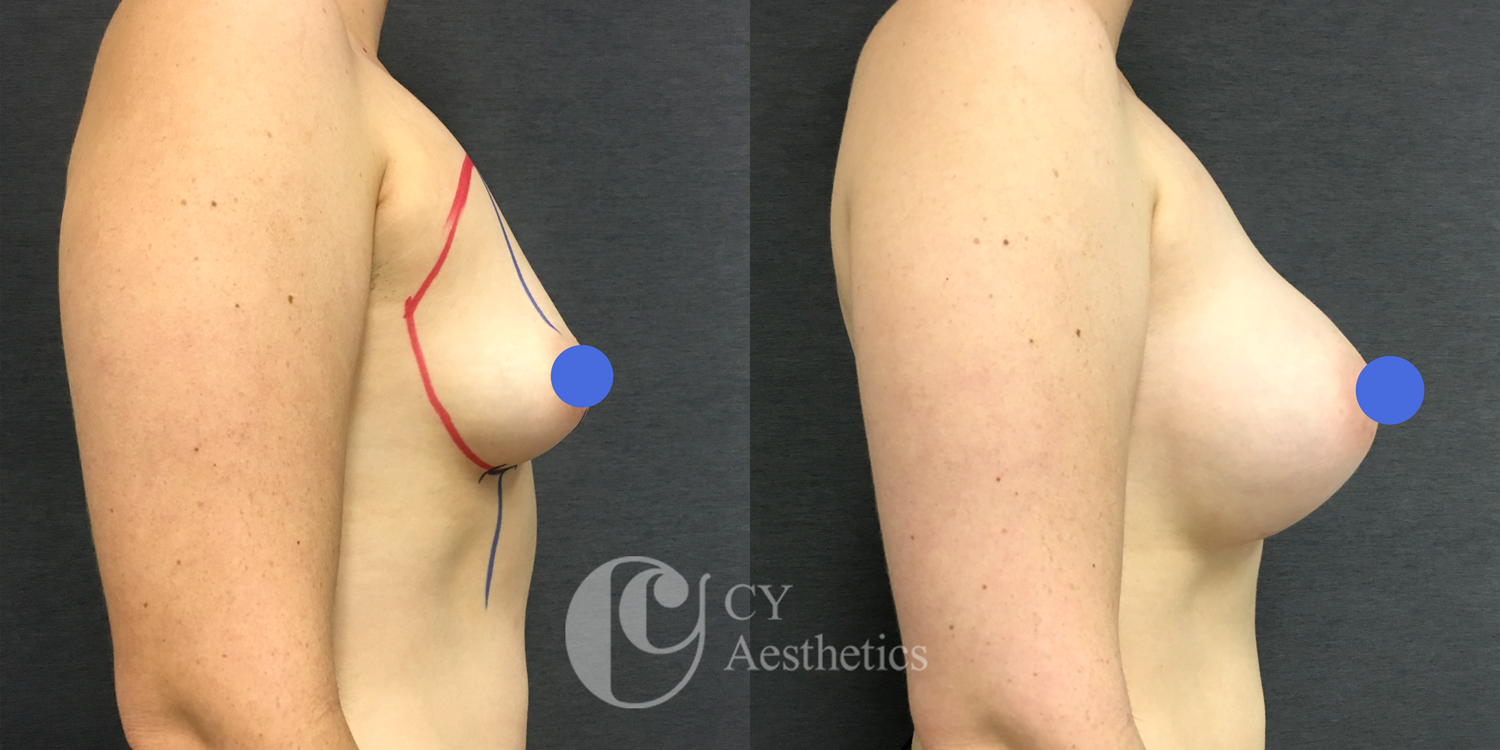 Breast Augmentation