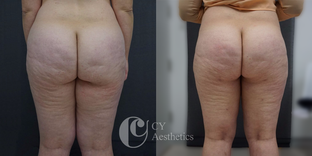Thighs and Buttocks Liposuction