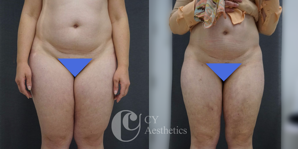 Thighs and Buttocks Liposuction