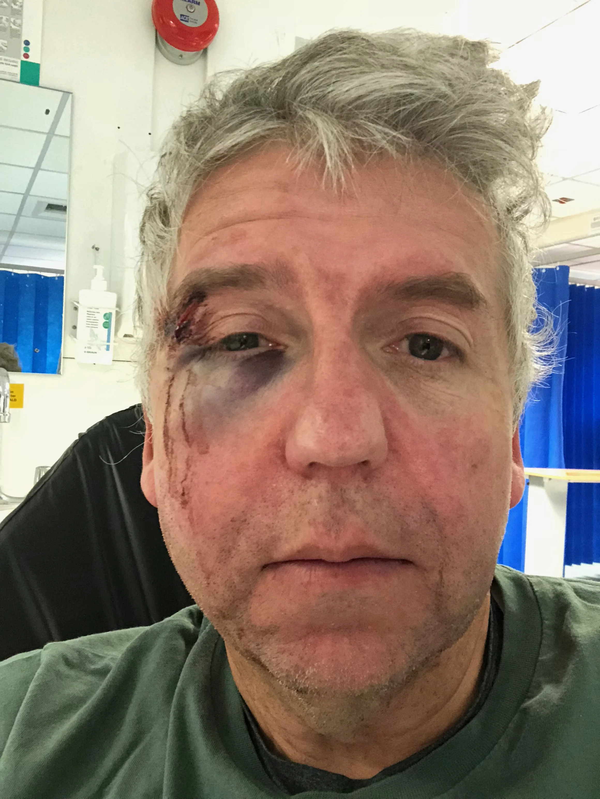 A nasty fall but at least it didn't ruin my good looks, and I was able to call my wife for help using Apple Watch 3 LTE while writhing in pain on the floor..