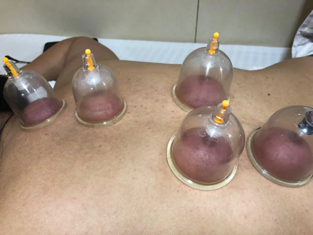 Cupping for weight loss / pain relief