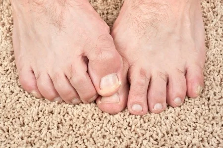 15564518_S_Nail_Fungus_Toes_itch.jpg
