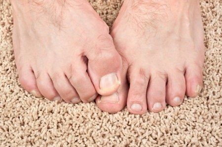 15564518_S_Nail_Fungus_Toes_itch.jpg