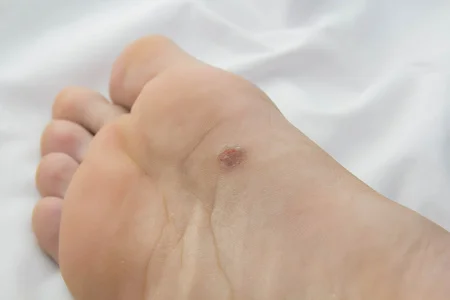 105813454_S_foot_cancer_melanoma_screening_man_ball.jpg