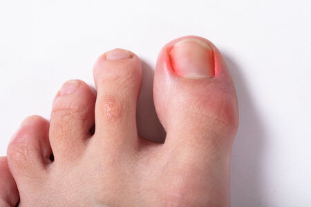 Ingrown Toenails  Advanced Foot & Ankle Care Specialists
