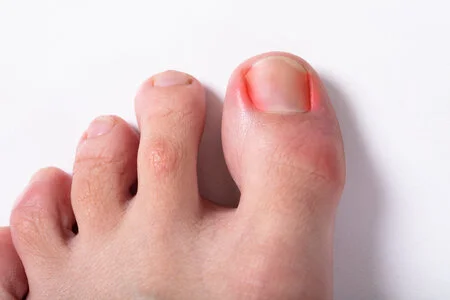 121140431_S_ingrown_toenail_red_sore_pain_toe.jpg