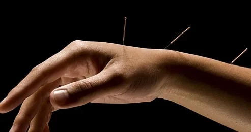 photolibrary_rf_photo_of_acupuncture_in_arm.jpg
