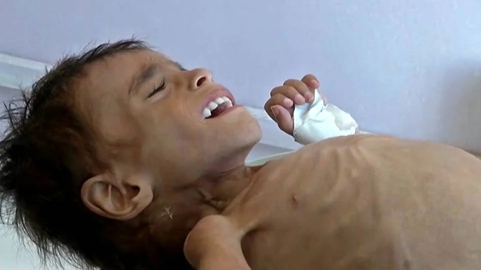 U.N.: A Yemeni Child Dies Every 10 Min. from War-Caused Disease, Hunger