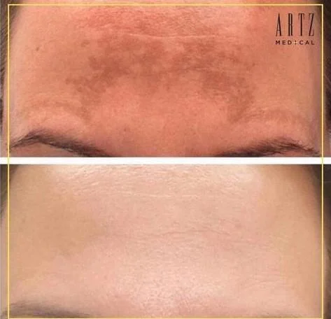 “Al jaren stoorde ik me aan de pigmentvlek op mijn voorhoofd, Hij leek steeds groter te worden. Ik ben bij een andere kliniek begonnen met een laser behandeling, echter met een andere laser. Deze gaf niet voldoende resultaat. Via een vriendin ben ik bij Artz Medical gekomen, zij vertelde dat daar gewerkt wordt met één van de nieuwste lasers. Na 1 behandeling had ik al meer resultaat dan voorheen na 3 behandelingen. Zeker een aanrader!”