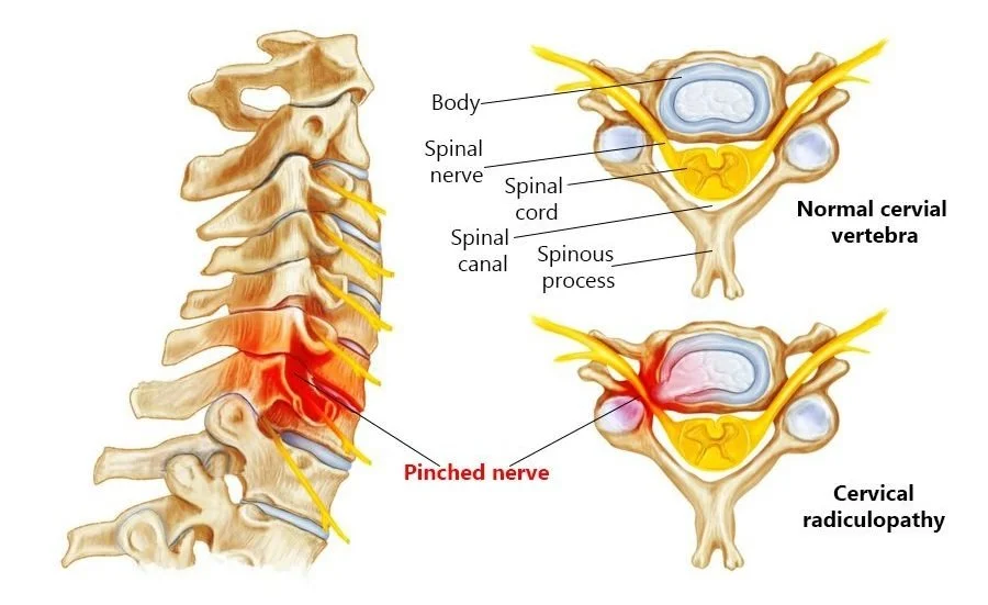 Cervical radiculopathy: a common cause of neck shoulder and arm pain