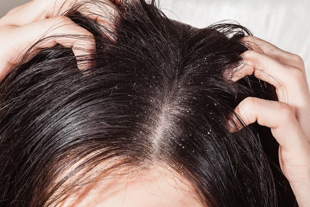 Scalp Issues