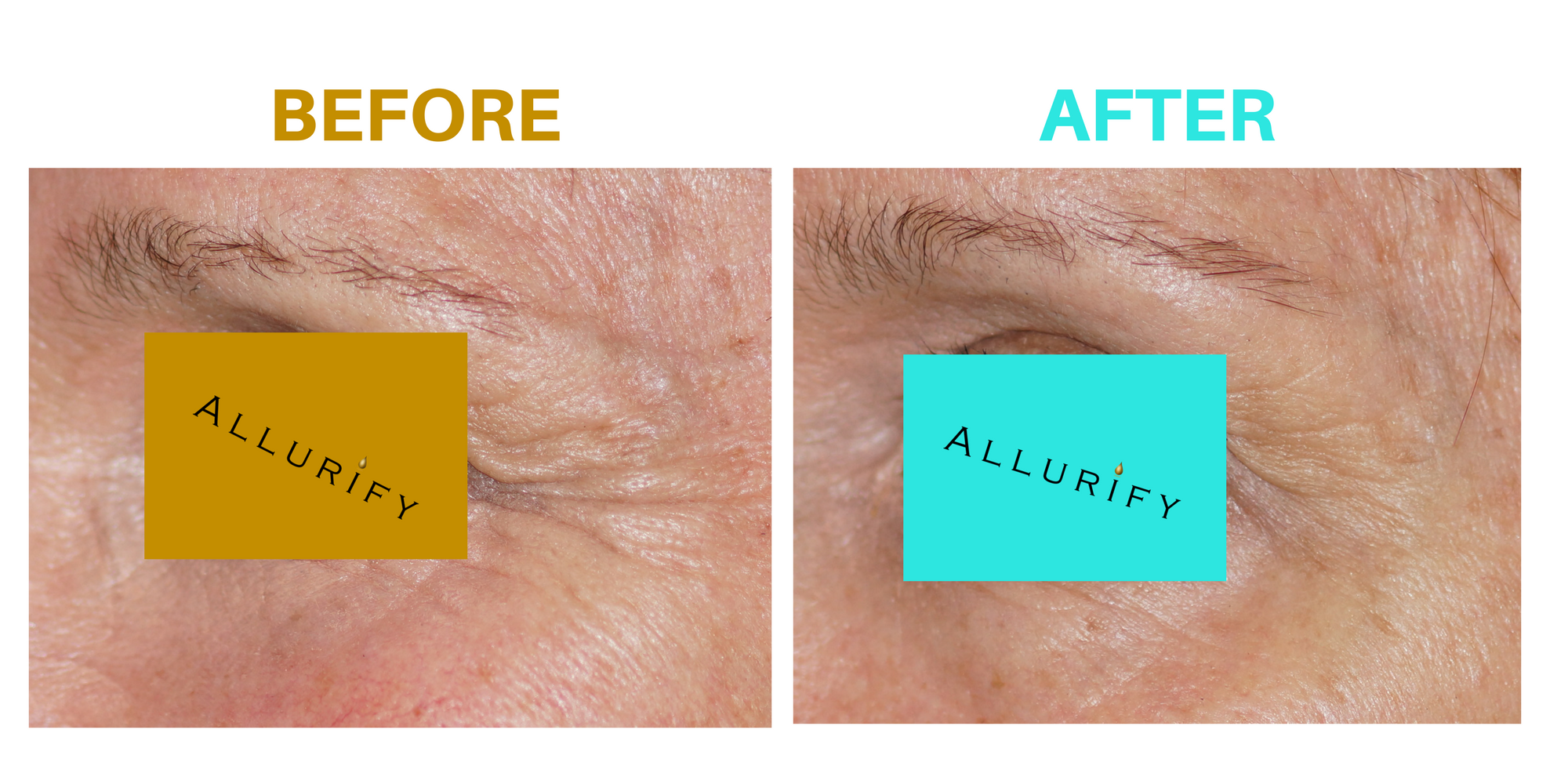 17_Allurify_ Before & After_crows feet L.png