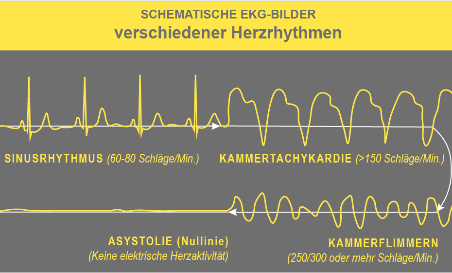 EKG-Rhythmen