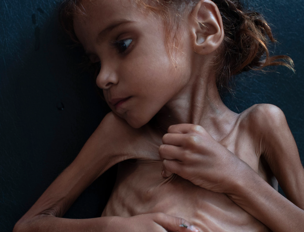 A seven year-old Yemeni girl named Amal Hussain suffers from acute malnutrition as a result of an impending widespread famine in Yemen. Photo: Tyler Hicks/ The New York Times