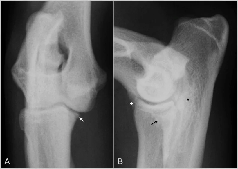 Fig 2 A y B. A: En la enfermedad del proceso coronoides medial el signo radiográfico más evidente es la visualización del fragmento óseo libre (flecha blanca). B: Otros signos radiológicos sugerentes, pero no concluyentes, son: pérdida de definición del margen craneal del proceso coronoides medial (flecha negra), esclerosis en la escotadura troclear del cúbito (asterisco negro) y/o signos degenerativos secundarios (asterisco blanco).