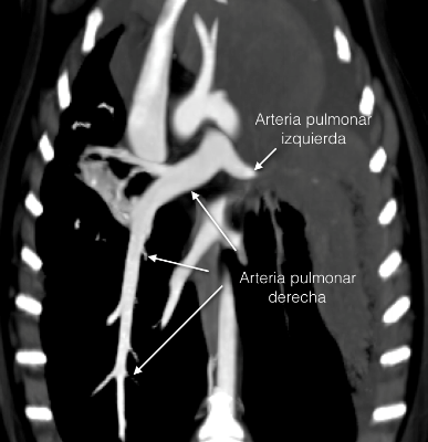 Figura 5. Reconstrucción dorsal postcontraste donde se observa la terminación abrupta de la arteria pulmonar izquierda (donde cabría esperar la rama del lóbulo craneal).