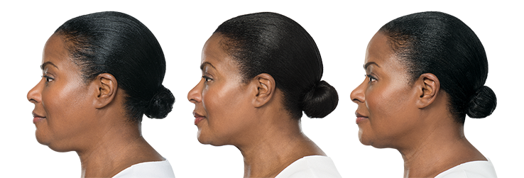 KYBELLA B&A 4.png