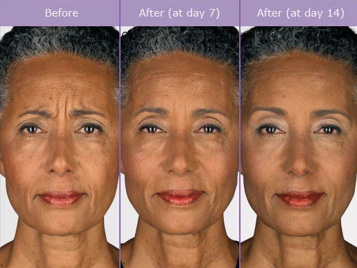 BOTOX BEFORE AND AFTER 3.jpg
