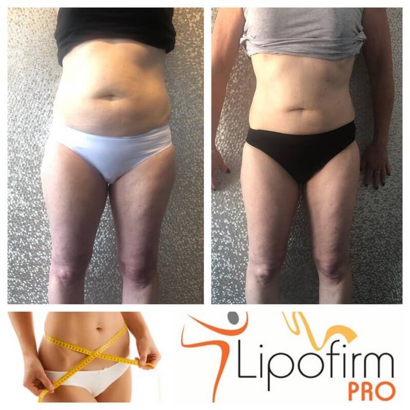 Lipofirm 2.jpg