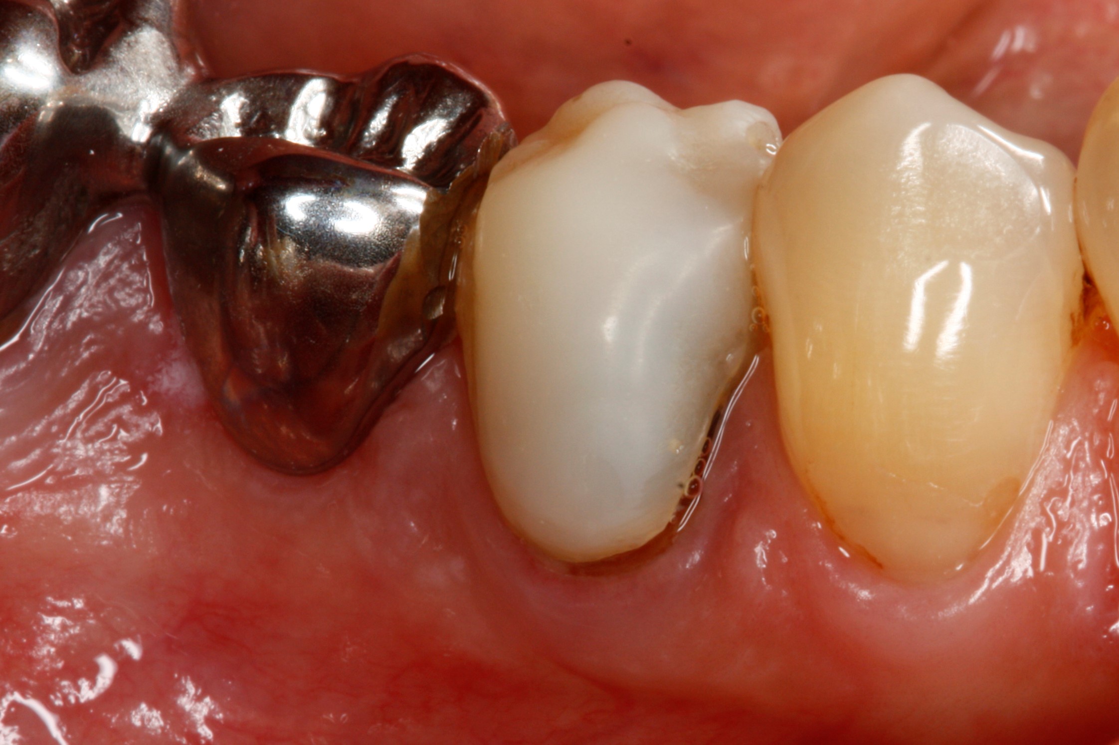 This tooth has a failing temporary crown
